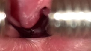 URETHRAL SOUNDING